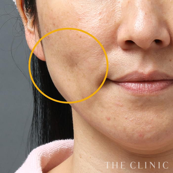 こけた頬のマイクロCRF注入(顔の脂肪注入)（40歳女性）の術前写真