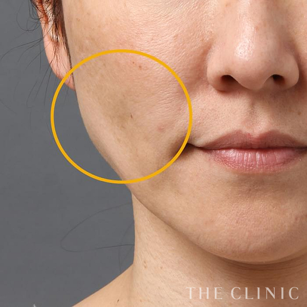 こけた頬のマイクロCRF注入(顔の脂肪注入)（40歳女性）の術後写真