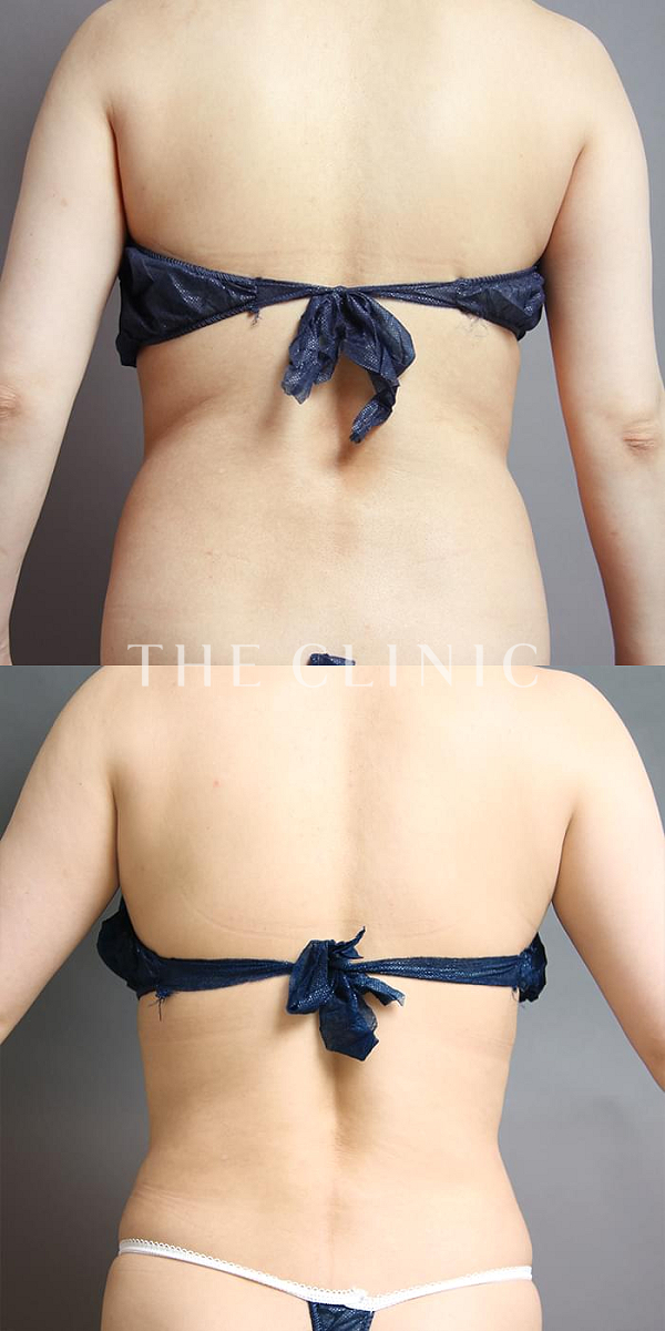 腰・ウエストのベイザー脂肪吸引（39歳女性）の術前・術後写真