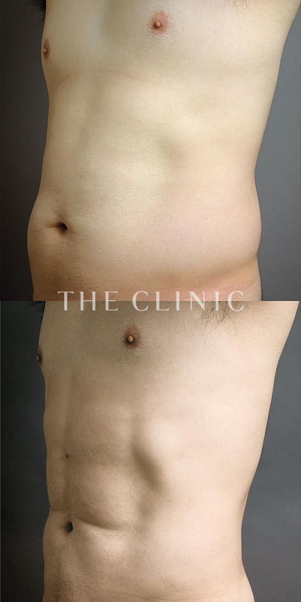 胸部のデザイン・SIX PACK ６つに割れた腹筋のベイザー4D(男性のシックスパック脂肪吸引)（41歳男性）の術前・術後写真