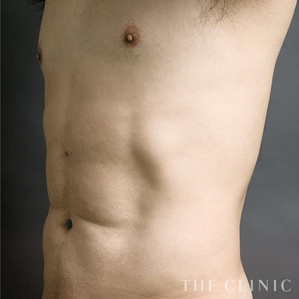 胸部のデザイン・SIX PACK ６つに割れた腹筋のベイザー4D(男性のシックスパック脂肪吸引)（41歳男性）の術後写真
