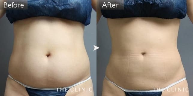 腹部／腰・ウエスト（女性／32歳）