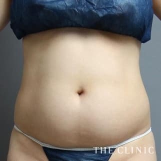 【THE CLINIC 症例画像】No.615_1_腹部_360脂肪吸引®