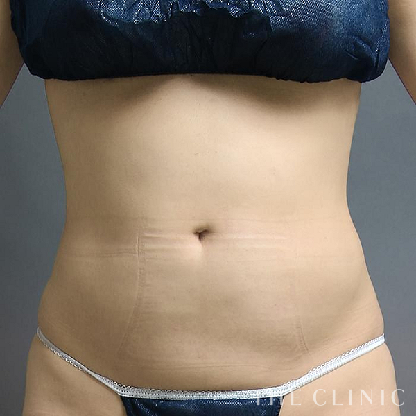 腹部・腰・ウエストのベイザー脂肪吸引（32歳女性）の術後写真