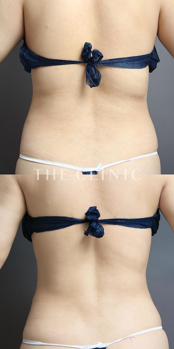 背中・腰・ウエストのベイザー脂肪吸引（32歳女性）の術前・術後写真