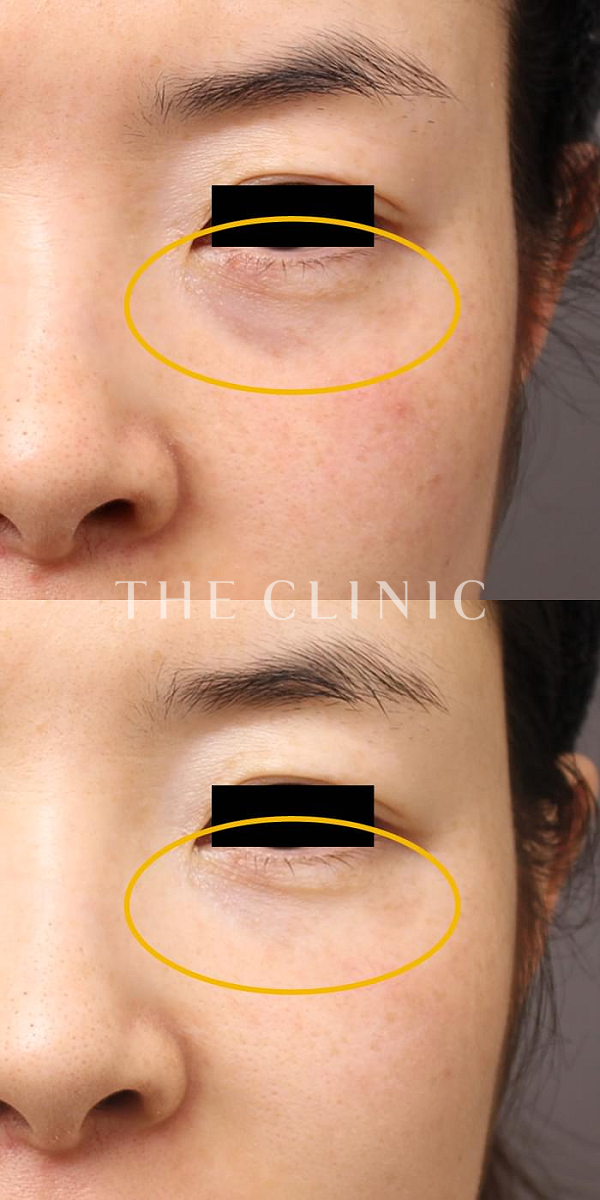 目の下のクマのマイクロCRF注入(顔の脂肪注入)（33歳女性）の術前・術後写真