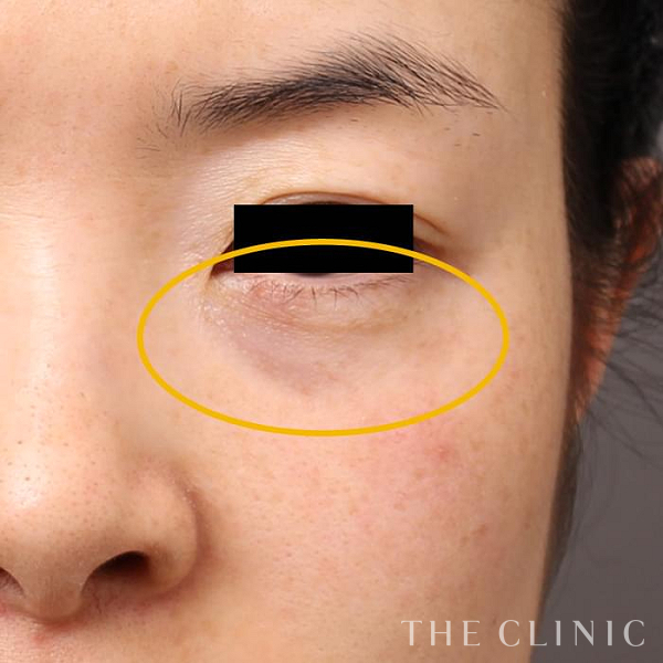 目の下のクマのマイクロCRF注入(顔の脂肪注入)（33歳女性）の術前写真