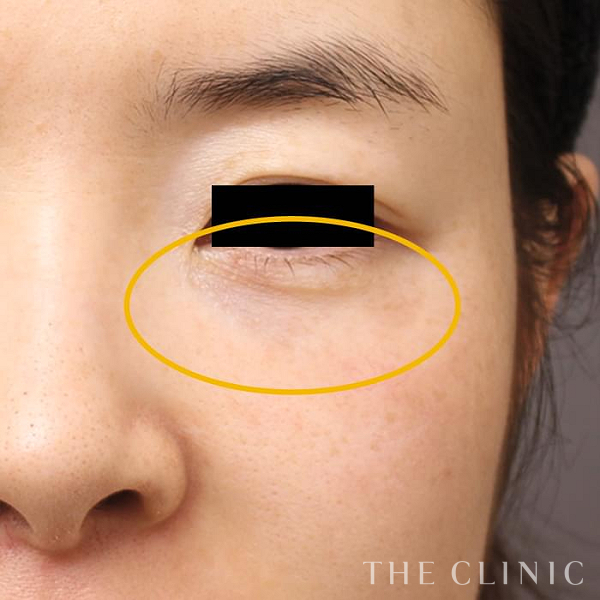 目の下のクマのマイクロCRF注入(顔の脂肪注入)（33歳女性）の術後写真