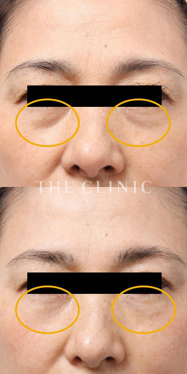 目の下のクマのマイクロCRF注入(顔の脂肪注入)（62歳女性）の術前・術後写真