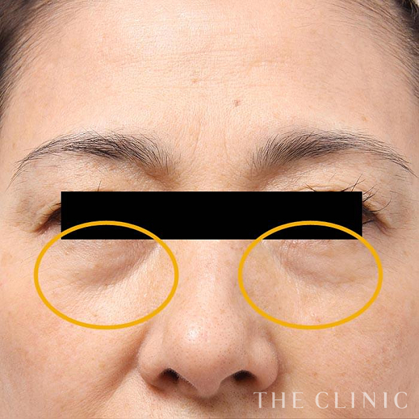 目の下のクマのマイクロCRF注入(顔の脂肪注入)（62歳女性）の術前写真