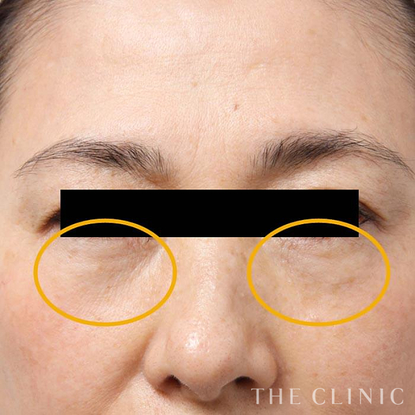 目の下のクマのマイクロCRF注入(顔の脂肪注入)（62歳女性）の術後写真