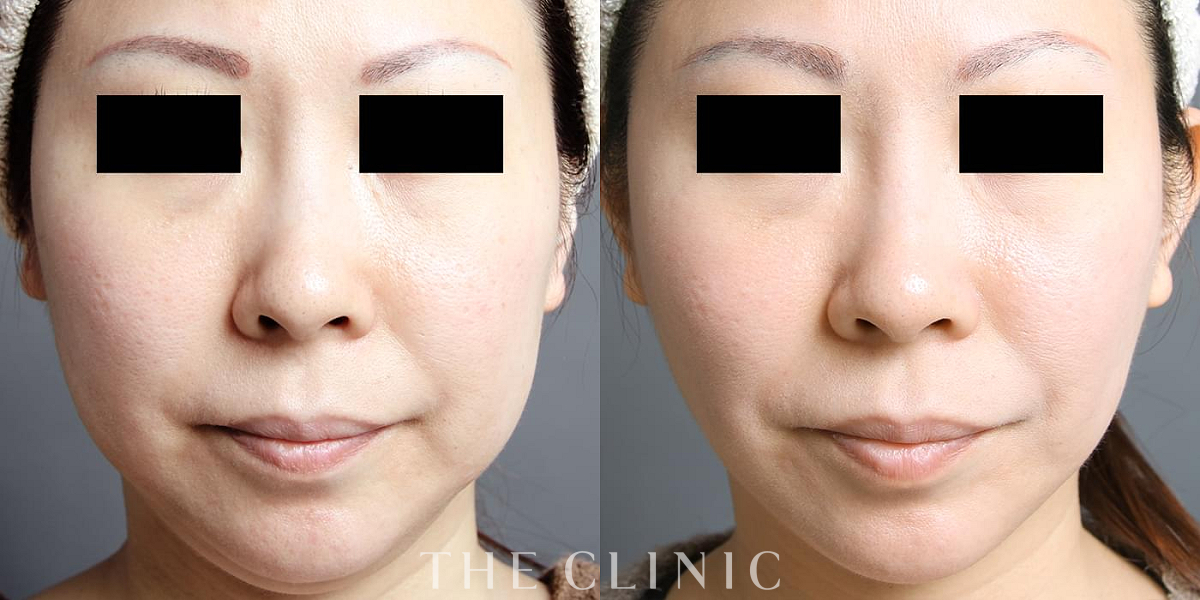 ベイザー脂肪吸引の術前/術後