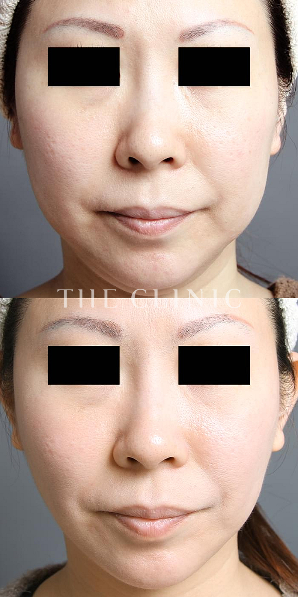 頰／顎のベイザー脂肪吸引（39歳女性）の術前・術後写真