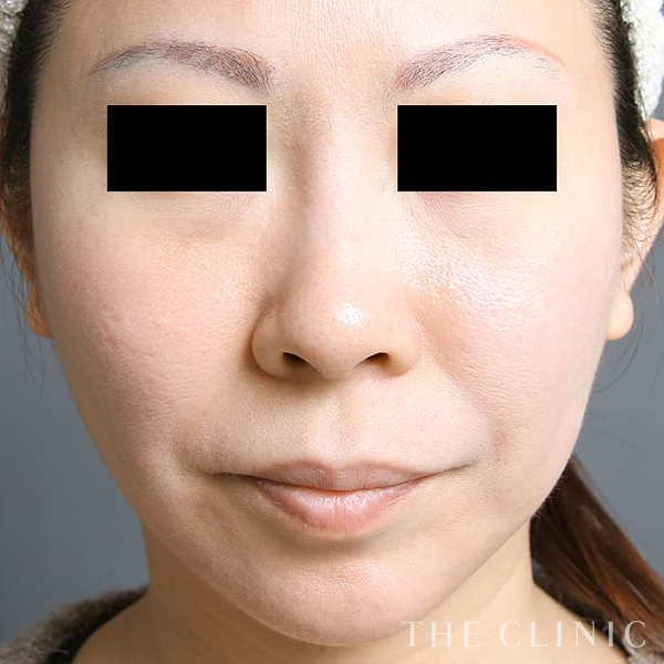 頰／顎のベイザー脂肪吸引（39歳女性）の術後写真