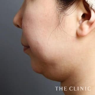 【THE CLINIC 症例画像】No.624_1_頰/顎_360脂肪吸引®