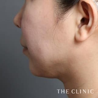 【THE CLINIC 症例画像】No.624_2_頰/顎_360脂肪吸引®