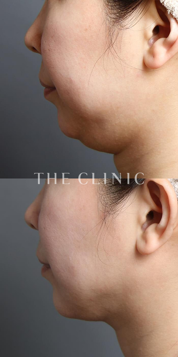 頰／顎のベイザー脂肪吸引（39歳女性）の術前・術後写真