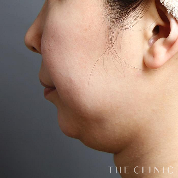 頰／顎のベイザー脂肪吸引（39歳女性）の術前写真