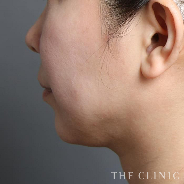 頰／顎のベイザー脂肪吸引（39歳女性）の術後写真