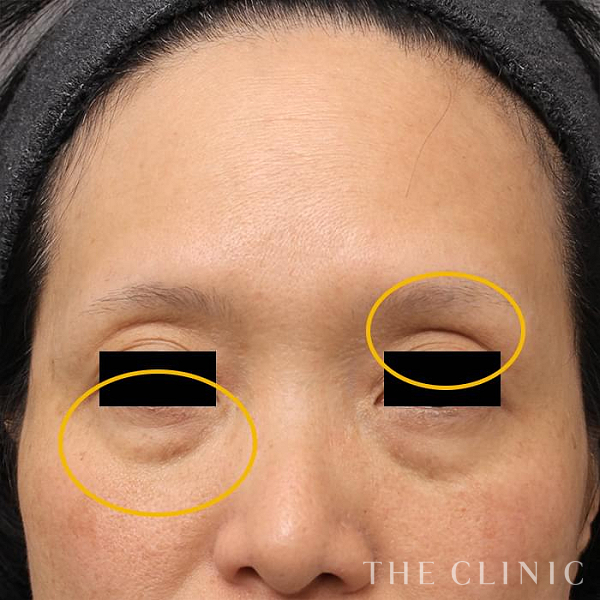 目の上のくぼみ・目の下のクマのマイクロCRF注入(顔の脂肪注入)（53歳女性）の術前写真