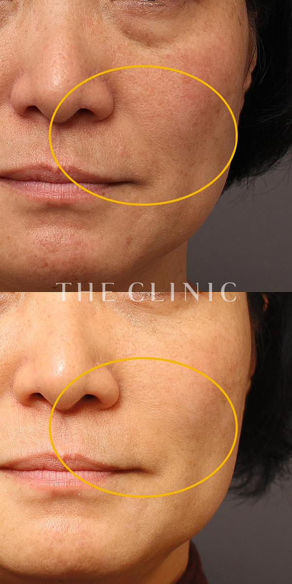 法令線のマイクロCRF注入(顔の脂肪注入)（53歳女性）の術前・術後写真