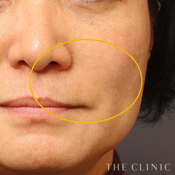 法令線のマイクロCRF注入(顔の脂肪注入)（53歳女性）の術後写真