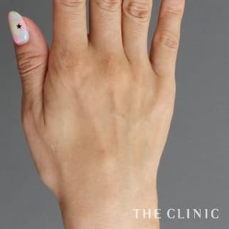 【THE CLINIC 症例画像】No.630_1_手のシワ_手の甲への脂肪注入(ハンドリバイブ)(執刀医：)
