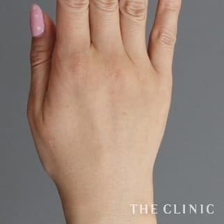 【THE CLINIC 症例画像】No.630_2_手のシワ_手の甲への脂肪注入(ハンドリバイブ)(執刀医：)