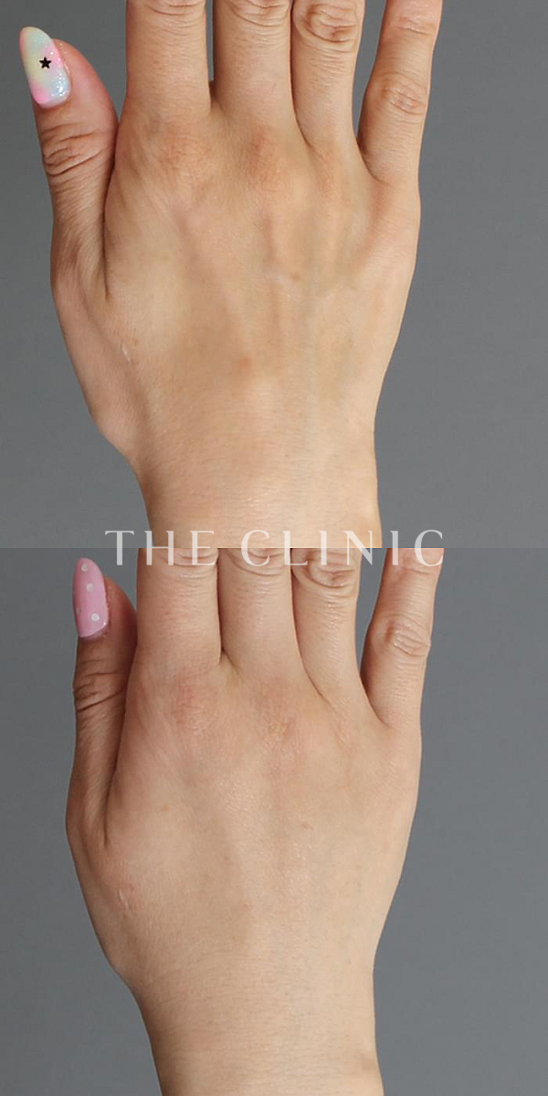 手のシワの手の甲への脂肪注入(ハンドリバイブ)（44歳女性）の術前・術後写真