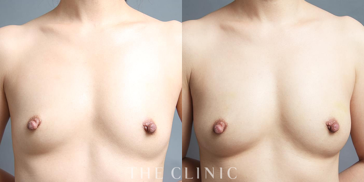 コンデンスリッチ豊胸の術前/術後