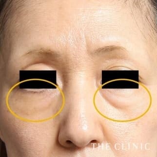 【THE CLINIC 症例画像】No.632_1_目の下のクマ_マイクロCRF注入(顔の脂肪注入)(執刀医:村田 八千穂)