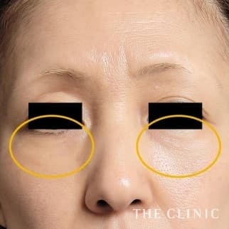 【THE CLINIC 症例画像】No.632_2_目の下のクマ_マイクロCRF注入(顔の脂肪注入)(執刀医:村田 八千穂)