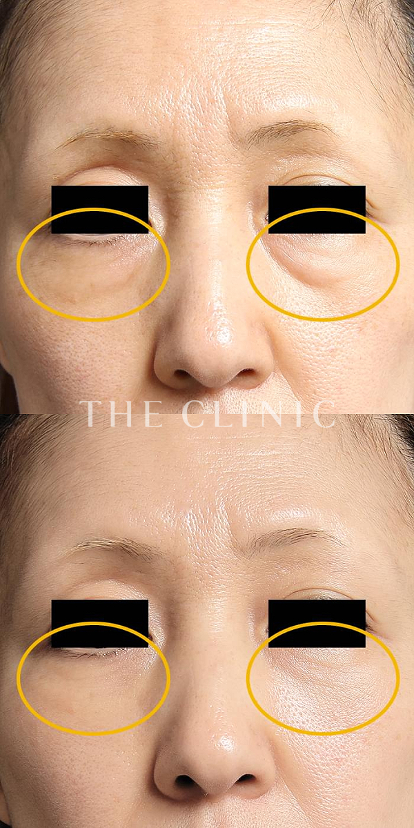 目の下のクマのマイクロCRF注入(顔の脂肪注入)（50歳女性）の術前・術後写真