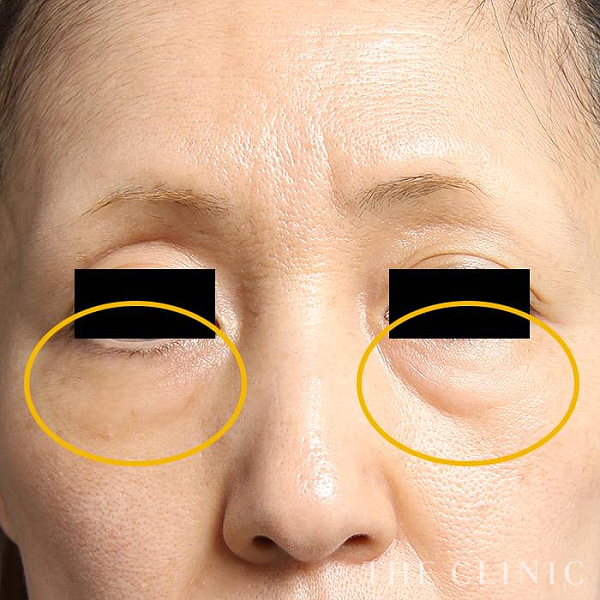 目の下のクマのマイクロCRF注入(顔の脂肪注入)（50歳女性）の術前写真