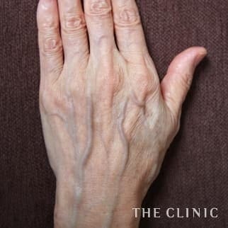 【THE CLINIC 症例画像】No.633_1_手のシワ_手の甲への脂肪注入(ハンドリバイブ)(執刀医：大橋 昌敬)