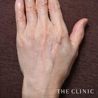 【THE CLINIC 症例画像】No.633_2_手のシワ_手の甲への脂肪注入(ハンドリバイブ)(執刀医:大橋 昌敬)