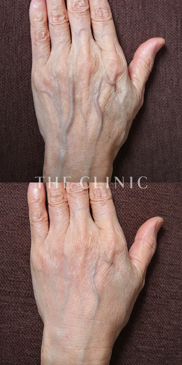 手のシワの手の甲への脂肪注入(ハンドリバイブ)（65歳女性）の術前・術後写真