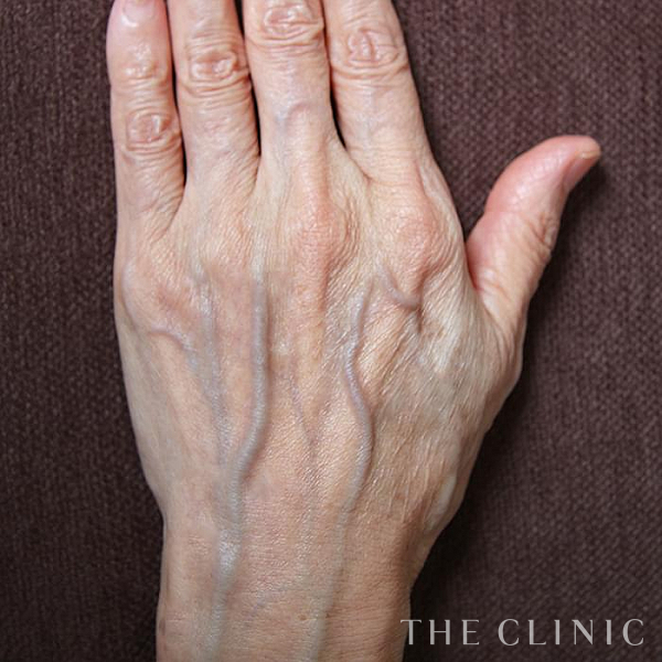 手のシワの手の甲への脂肪注入(ハンドリバイブ)（65歳女性）の術前写真