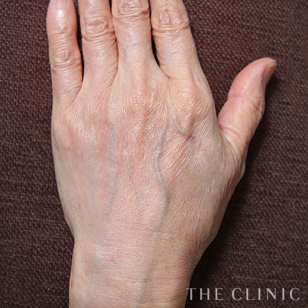 手のシワの手の甲への脂肪注入(ハンドリバイブ)（65歳女性）の術後写真