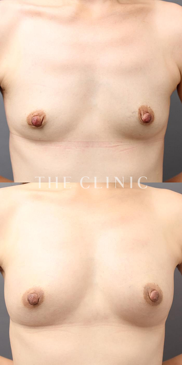 ボリュームアップのコンデンスリッチ豊胸（41歳女性）の術前・術後写真