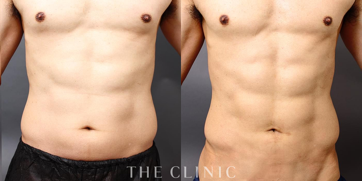 360脂肪吸引®の術前／術後