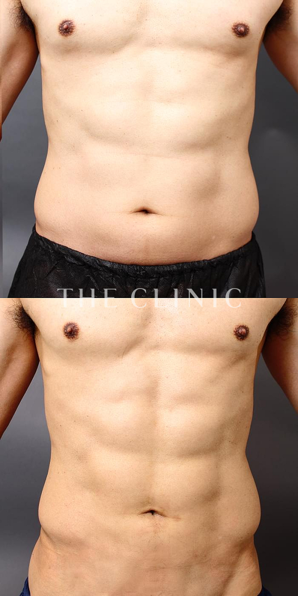 腹部・SIX PACK ６つに割れた腹筋の360脂肪吸引®（52歳男性）の術前・術後写真