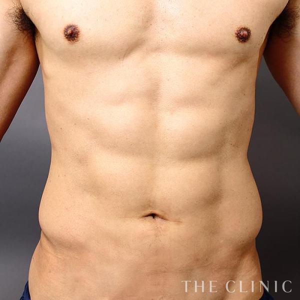 腹部・SIX PACK ６つに割れた腹筋の360脂肪吸引®（52歳男性）の術後写真