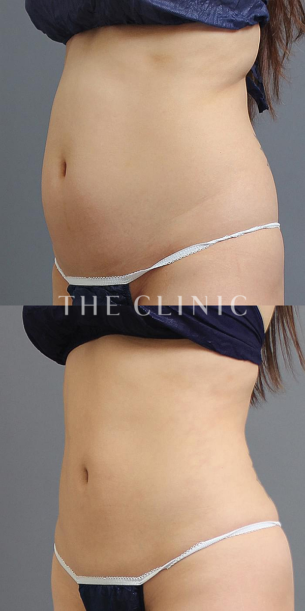 腹部のベイザー脂肪吸引（24歳女性）の術前・術後写真