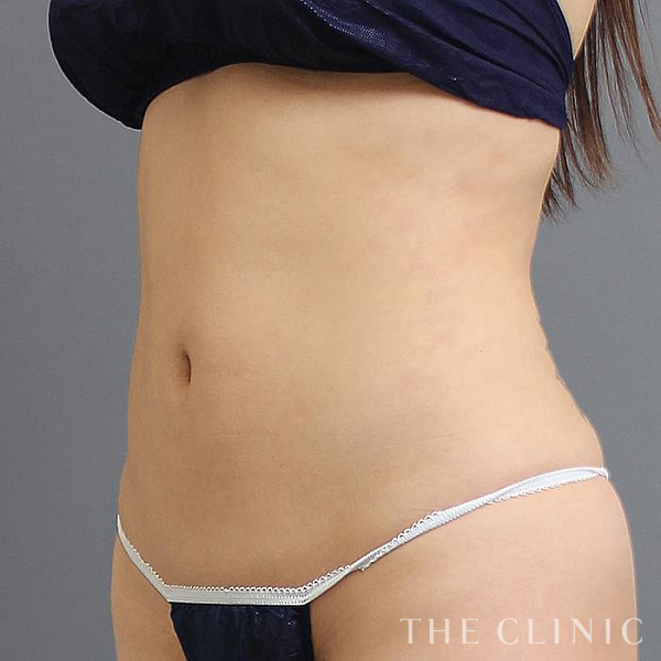 腹部のベイザー脂肪吸引（24歳女性）の術後写真