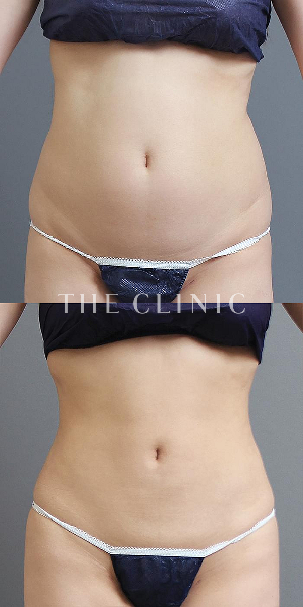 腹部のベイザー脂肪吸引（24歳女性）の術前・術後写真