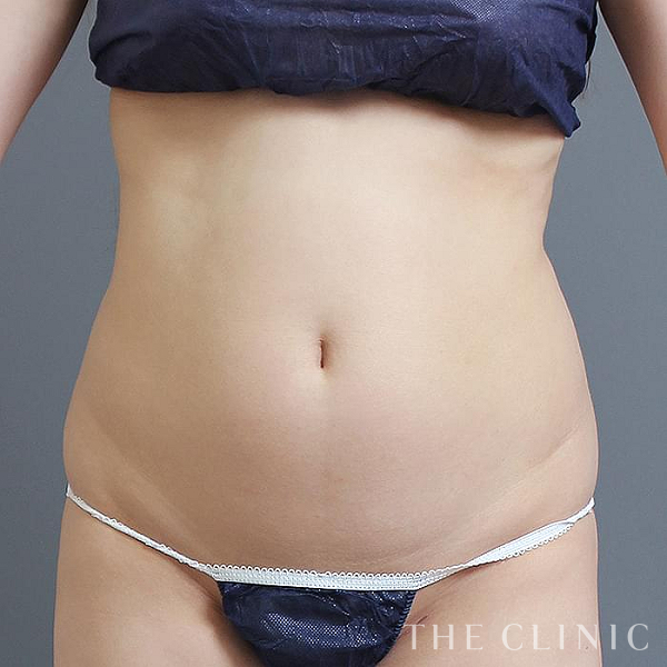 腹部のベイザー脂肪吸引（24歳女性）の術前写真