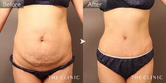 産後の腹部脂肪吸引の症例写真(タミータック)