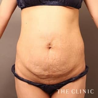 【THE CLINIC 症例画像】No.646_1_腹部_タミータック4D(お腹のたるみ解消)(執刀医:大橋 昌敬)