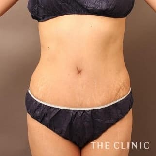 【THE CLINIC 症例画像】No.646_2_腹部_タミータック4D(お腹のたるみ解消)(執刀医:大橋 昌敬)